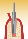 Einbringen des Implantats