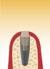 Einbringen des Implantats